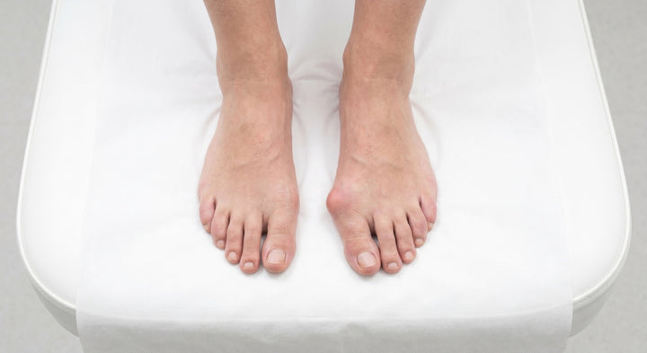 Hallux valgus: vad är det – och så lindrar du besvären
